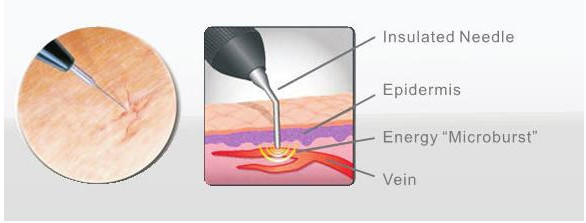 Derhal sonuç örümcek damar kaldırma varisli damarlar lazer tedavisi makinesi / vasküler cerrahi aletler